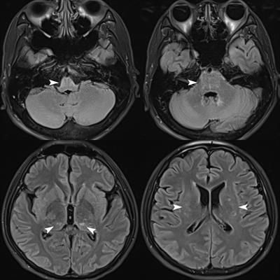 Plasma exchange for two patients with autoimmune GFAP astrocytopathy with rapid progression to respiratory failure: a case report